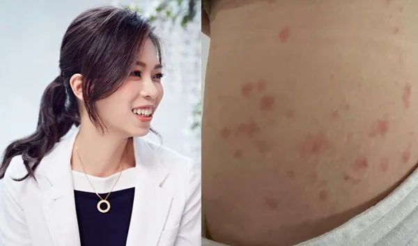 ▲▼ 。(圖/翻攝自Facebook/皮膚科日常菡養 高珮菡醫師)