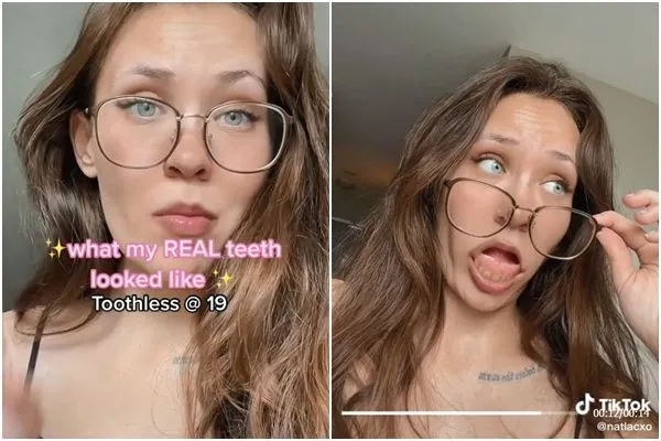 ▲▼溫哥華一名女子19歲時全口牙齒壞光光,必須戴假牙。(圖/翻攝自TikTok/natlacxo)