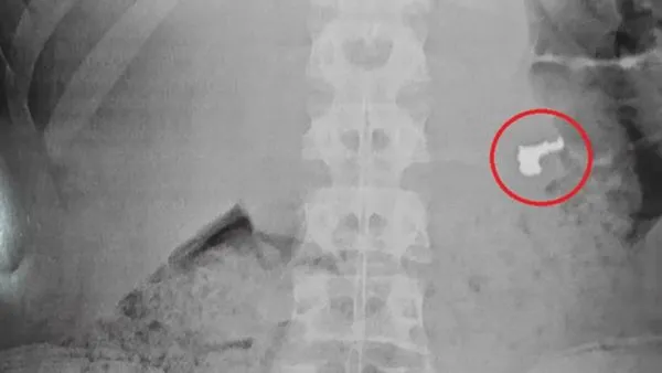 ▲▼巴西少年把偷來的金項鍊吞了。(圖/翻攝瓜魯雅市政廳)