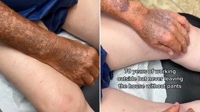 有防曬和沒防曬的差別！　醫師曝「70年皮膚差異」網看呆