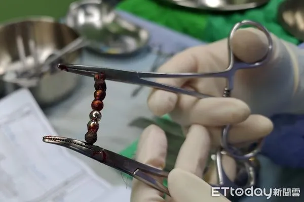 ▲▼ 2歲童誤吞磁力球,腸子穿孔 。(圖/輔大醫院提供)