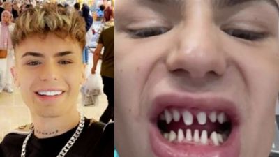 做美齒貼片慘變「鯊魚尖牙」！鮮肉滿嘴膿血被迫拔光真牙　噴了近30萬台幣