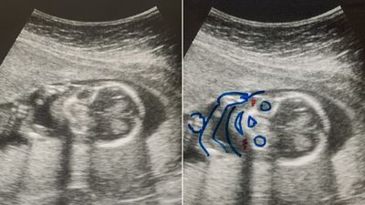 醫生給孕婦2張照「一張親手繪製人臉圖」　寶寶在哪一看就懂