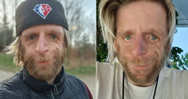 男子喬諾罹患罕見疾病,臉部會變形扭曲。(圖/翻攝自Jono Lancaster IG)