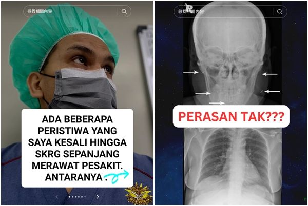 ▲▼馬來西亞一名醫生分享他過去曾遇過一名女患者，直到死前都不願意拔出植入在體內的巫術細針。（圖／翻攝自TikTok帳號@pakar.mata）
