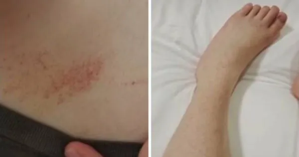 身體突冒大量紅點瘀青 女大生堅持旅遊…回程才就醫「被下病危通知」