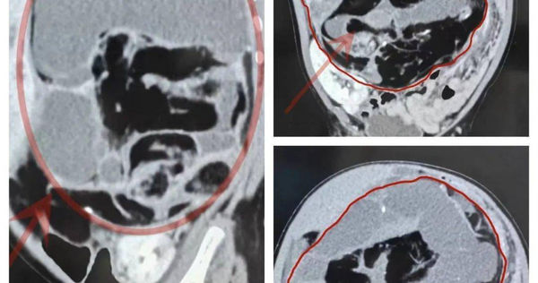 16斤女嬰肚子長5斤多大腫瘤,腹腔內器官全錯位。(圖/翻攝自微博)