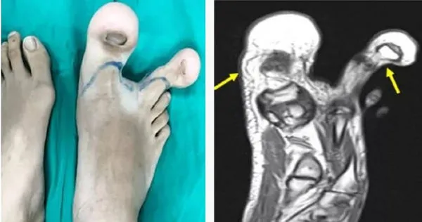 12歲女孩罹怪病長出「浩克腳趾」 她被截肢卻笑:終於能穿鞋了