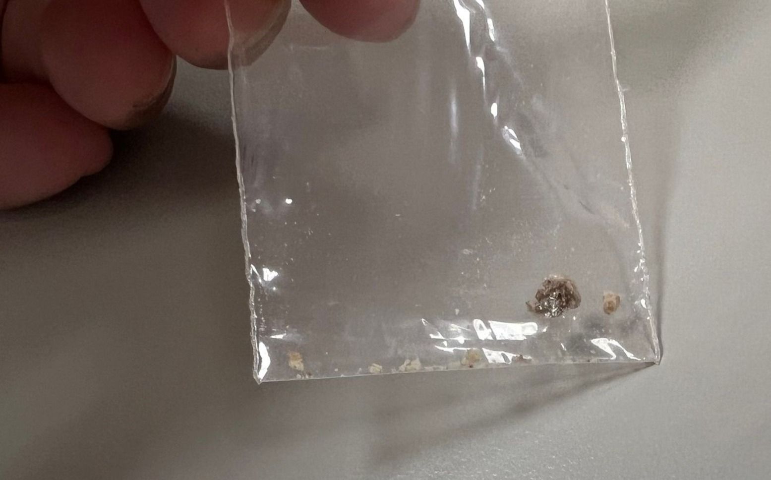 ▲▼女子「小便痠痛」求救!聽醫生建議狂灌水 尿出0.5公分結石。(圖/翻攝自臉書/引人入腎・林軒任醫師)