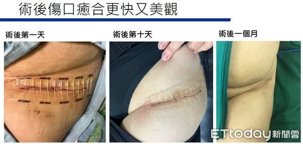 ▲▼ 嘉義長庚比基尼切口正前位髖關節手術 。(圖/記者翁伊森攝)