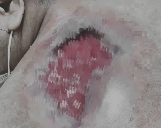 ▲女長疔子敷草藥引發蜂窩性組織炎。(圖/彰化醫院提供)