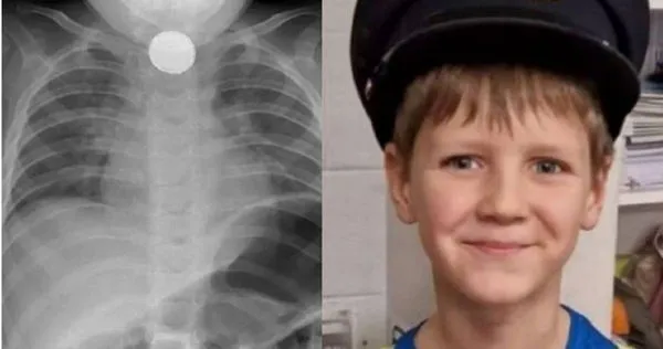 男童西考斯基(Aaron Sikorski)1歲1個月大時不慎吞下鈕扣電池。(圖/翻攝畫面)