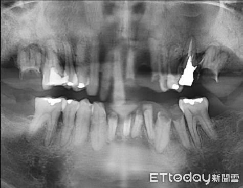 ▲牙齦纖維瘤。（圖／記者許宥孺攝）