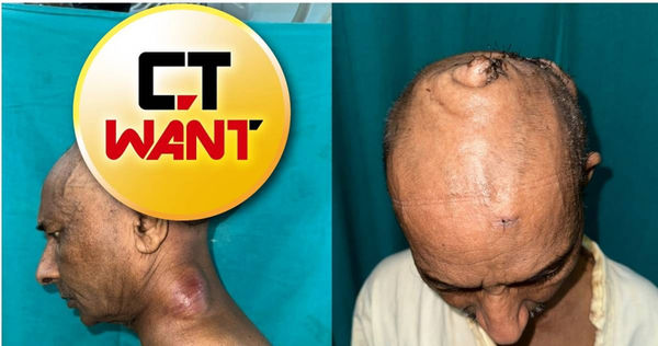 真硬頸！印度男頭頂「7公斤巨瘤」30年　手術移除變「光頭永澤」