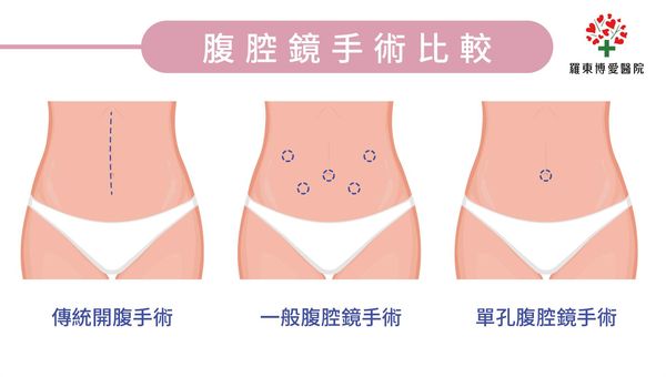 ▲▼羅東博愛醫院婦產科傅念慈醫師單孔腹腔鏡手術,為病患取出約10公分棒球大小卵巢囊腫。(圖/羅東博愛醫院提供,下同)