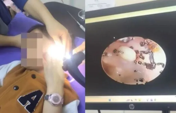 ▲▼馬來西亞一名女童耳朵疼痛,不料竟是因為耳蝸藏有大量跳蚤。(圖/翻攝自Facebook)