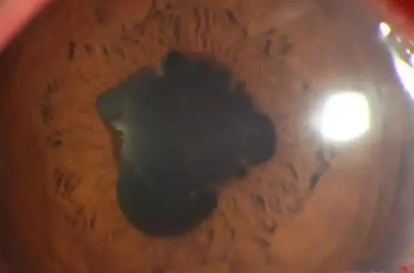 ▲▼過年熬夜追劇、打電動 他瞳孔變成「花瓣狀」。(圖/翻攝微博)