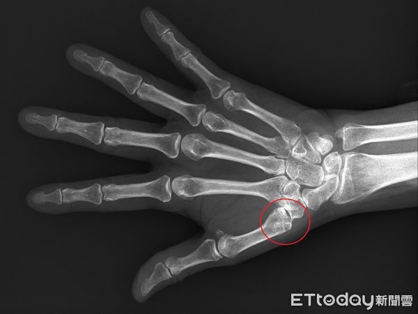 拇指關節鬆脫。(圖/台北慈濟醫院提供)