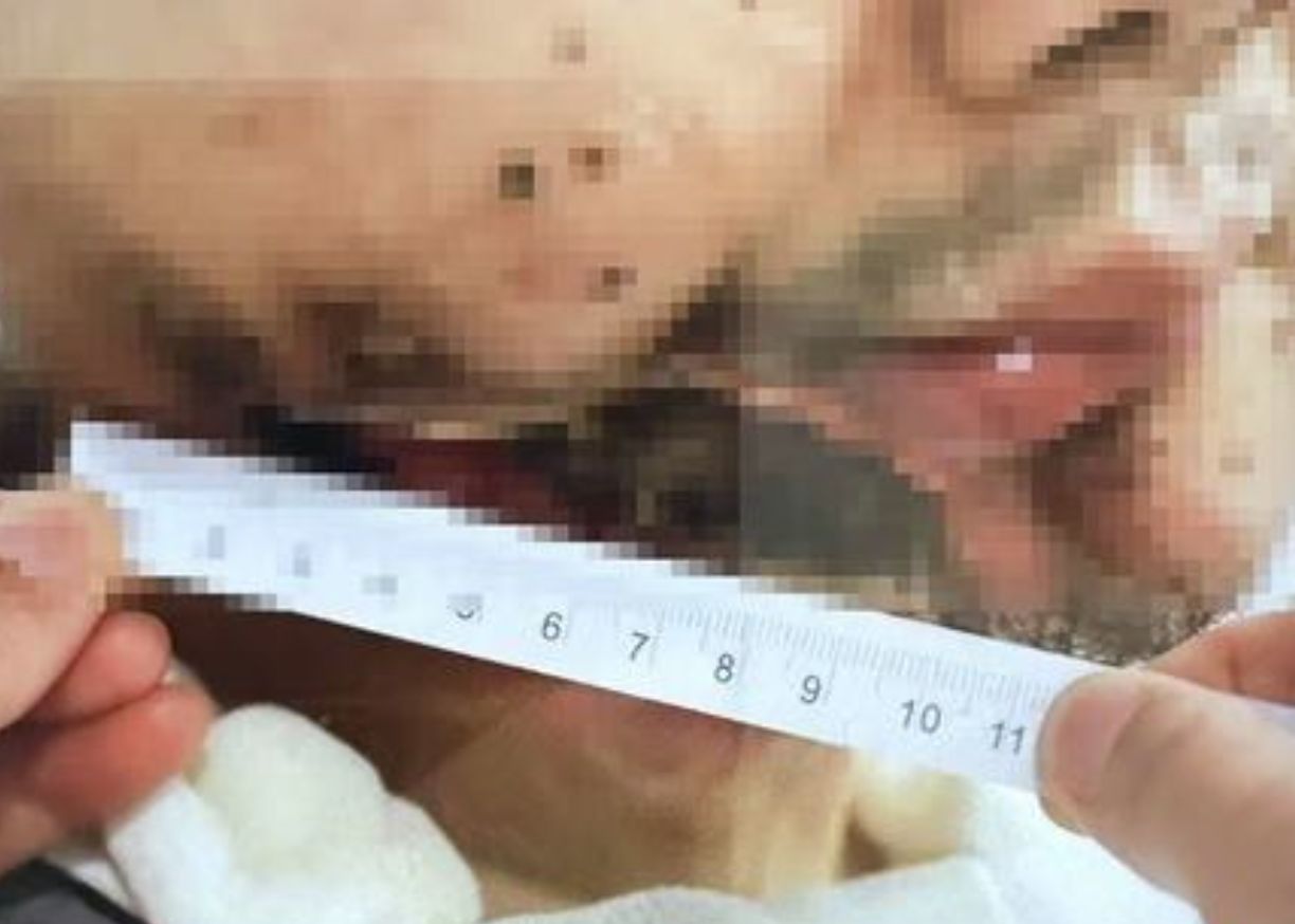 ▲山西張先生患口腔癌,誤信朋友開出的中藥,導致半張臉沒了。(圖/翻攝華商報)