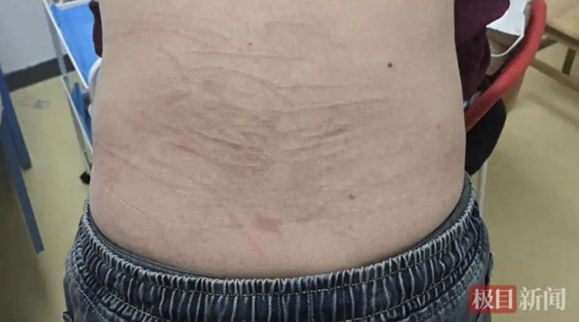 ▲武漢男子一覺醒來發現上半身佈滿被鞭打過後的痕跡。(圖/翻攝極目新聞)