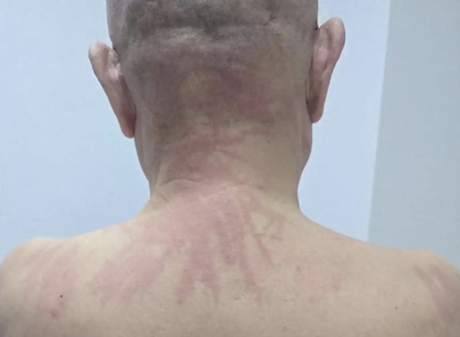 ▲武漢男子一覺醒來發現上半身佈滿被鞭打過後的痕跡。(圖/翻攝極目新聞)