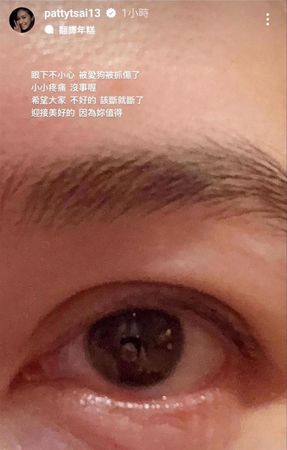 ▲蔡依珊受傷。(圖/翻攝自蔡依珊IG)