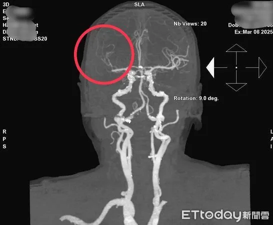 ▲電腦斷層血管攝影檢查,紅圈處可見病人腦部血管阻塞。(圖/衛福部南投醫院提供,下同)