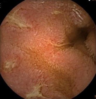 ▲▼男子罹患克隆氏症。(圖/馬偕醫院提供)