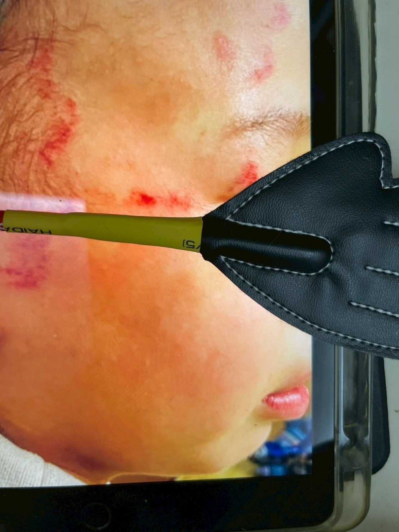 華華今年2月送到保母家不到1小時,臉上便出現怵目血痕,更與「愛的小手」痕跡高度重疊。(圖/讀者提供)