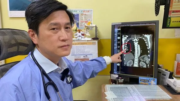 ▲▼員榮醫療體系員榮醫院醫療副院長涂川洲表示,患者感上類鼻疽菌,肺部有兩處膿瘍。(圖/員榮醫院提供)