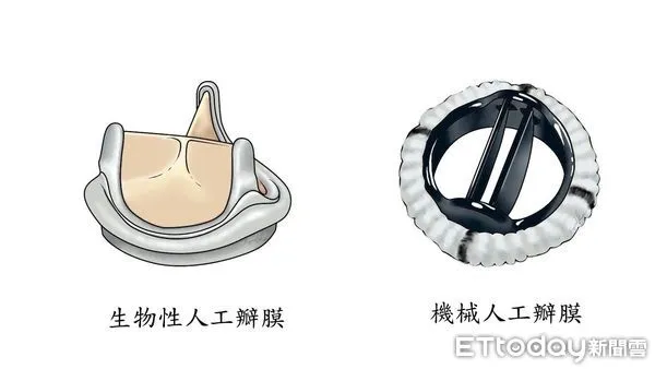 ▲長庚醫院最新研究證實置換人工瓣膜不宜僅依靠年齡作為依據。(圖/長庚醫院提供)