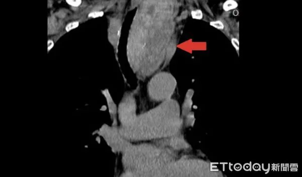 甲狀腺結節如芭樂般大。(圖/醫師提供)