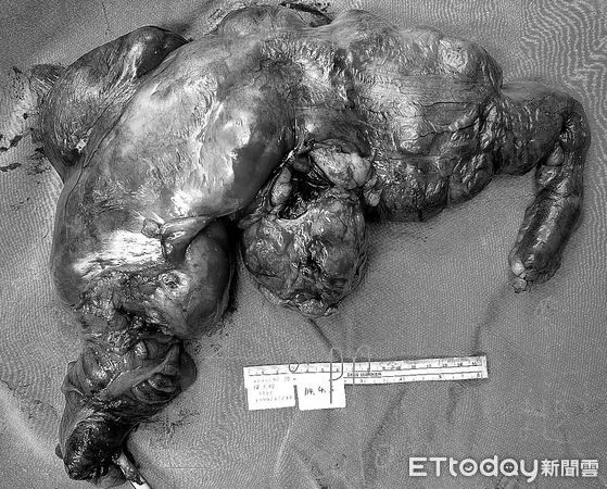 全球罕見!34歲男腹脹揭百顆小腸腫瘤。(圖/中山醫院提供)