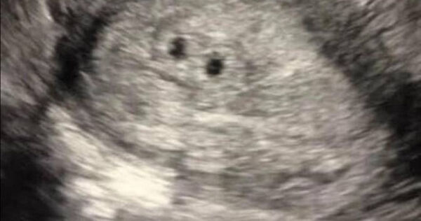 國外一名媽媽以為懷三胞胎,最後卻只生出1個寶寶。(圖/翻攝自vfbabygirl28 TikTok)