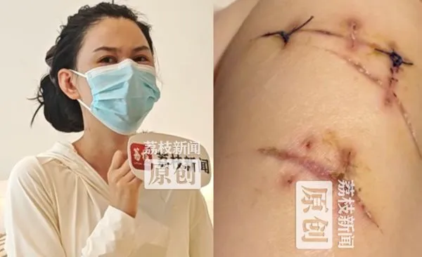 ▲▼「假奶擋刀」撿回一命!女子「挺過20多刀」慶幸有隆乳。(圖/翻攝微博)