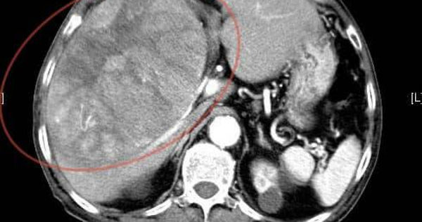 老翁肝臟有個15公分大的腫瘤,剛開始治療不久便病逝。(圖/翻攝自臉書/錢政弘 胃腸肝膽科醫師)