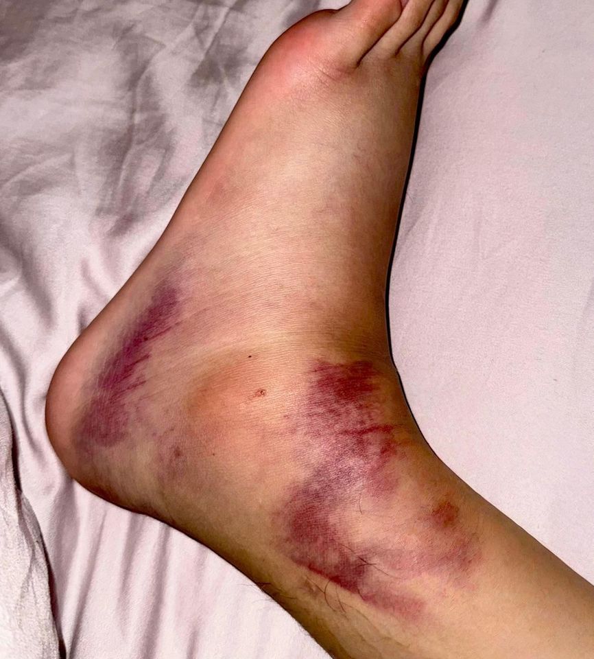 ▲▼洪暐哲右腳扭傷。(圖/年代整合行銷提供)