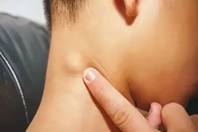 ▲▼5歲童脖子長一顆肉疙瘩,就醫確診癌症晚期。(圖/翻攝微博)