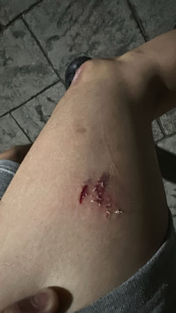 ▲▼台灣土狗追咬路人,皮開肉綻,飼主竟強辯「是牠自由」。(圖/(threads)zjtssmu_授權)