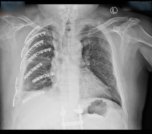 ▲國道工作人員撿拾布鉤繩遭到遊覽車撞擊。(圖/資料圖 彰化醫院提供)