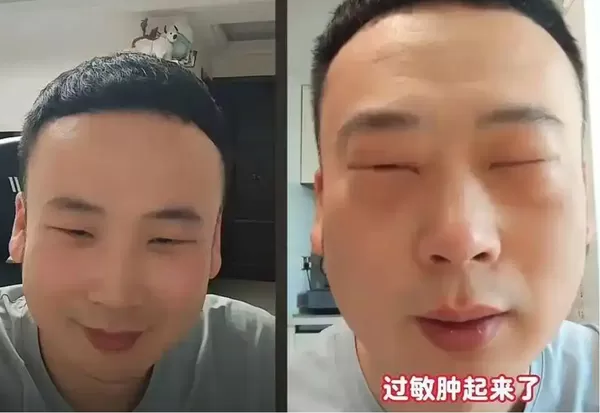 ▲▼ 大陸男子吃蟬蛹眼睛腫 。(圖/翻攝 封面新聞、百度)