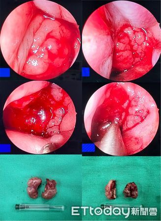 ▲孩子注意力不集中可能是兒童睡眠呼吸中止症導致。(圖/衛福部南投醫院提供)