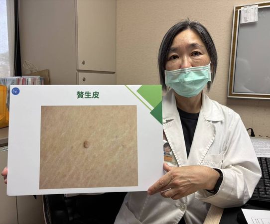 ▲▼書田診所整形美容科主任醫師黃季怡說明贅生皮(Skin Tags)。(圖/書田診所提供)