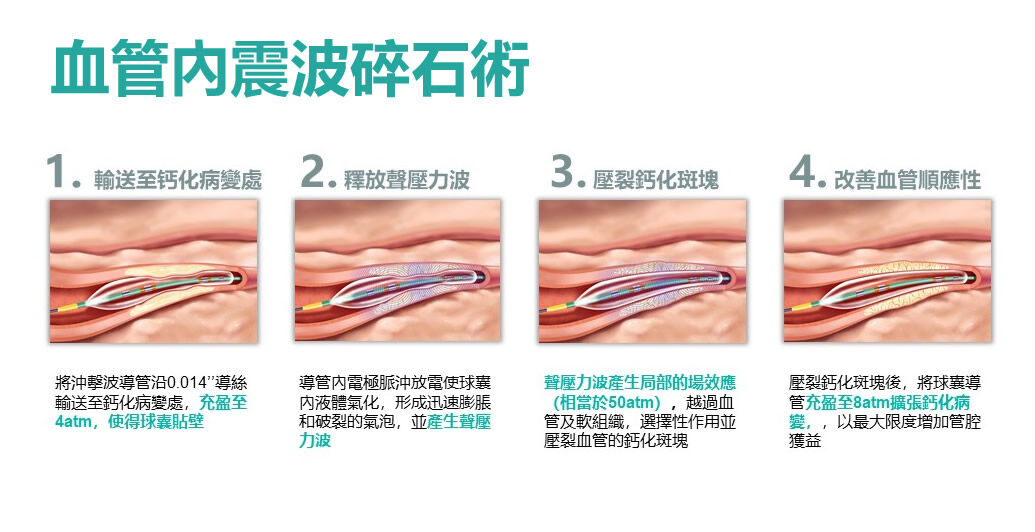 ▲血管內震波碎石術。(圖/安泰醫院提供)