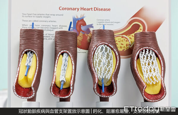 ▲血管內震波碎石術。(圖/安泰醫院提供)