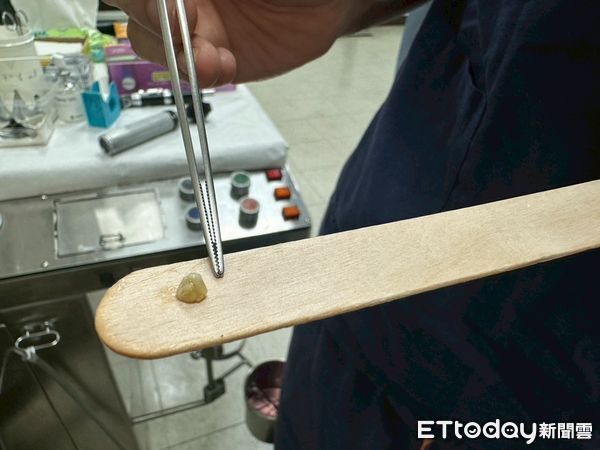 ▲▼ 嘉榮耳鼻喉科成功處理扁桃腺結石醫師提醒:小症狀也不可忽視 。(圖/嘉義榮民醫院提供)