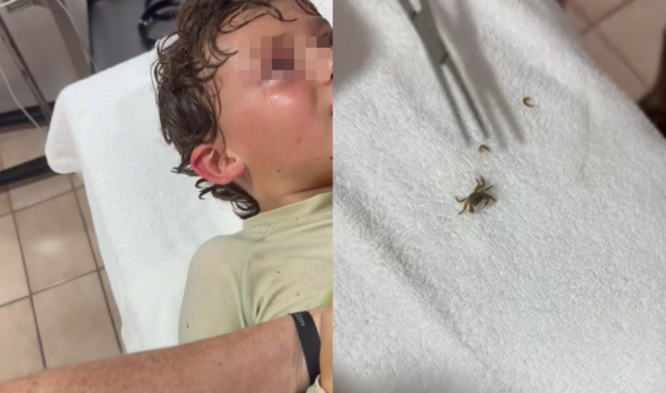 男童海邊遊玩覺得耳內有東西在動 醫夾出「活跳跳螃蟹」畫面曝。(圖/翻攝自TikTok/kitziamitre)