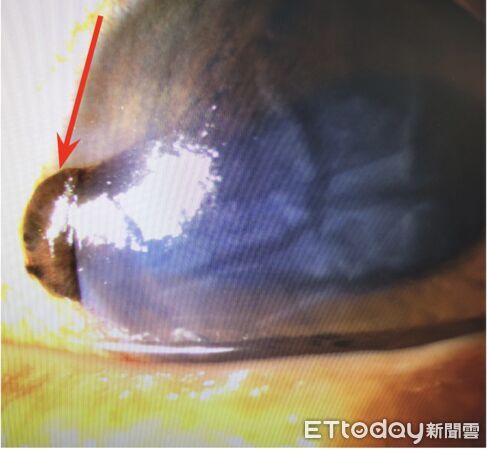 ▲虹膜持續從手術切口湧出(箭頭),此現象會加重超音波乳化術的困難度。(圖/記者吳奕靖翻攝)