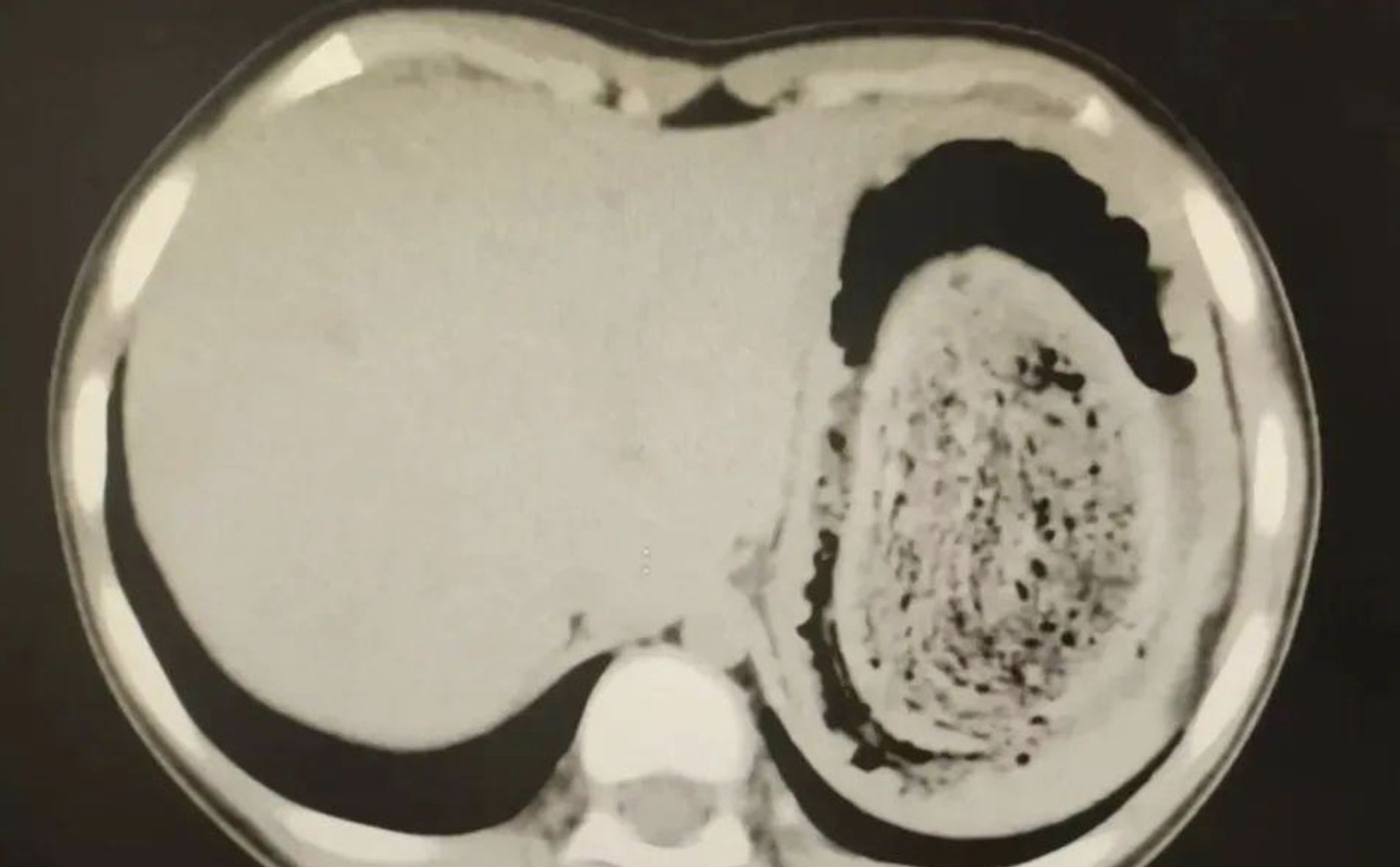 ▲女孩長期食用自己的頭髮,四分之三個胃都被填滿,形成「胃石」導致腹痛。(圖/翻攝廣州日報)