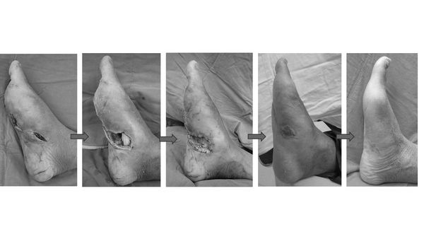 ▲▼馬偕傷口照護中心成效佳,加速病人傷口癒合,幫助病人免受截肢之苦。(圖/馬偕醫院提供)